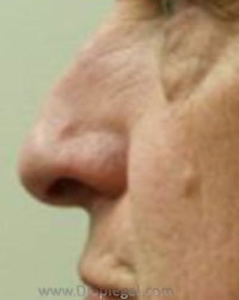 Rhinoplasty Before & After Gallery - Patient 157140512 - Image 1