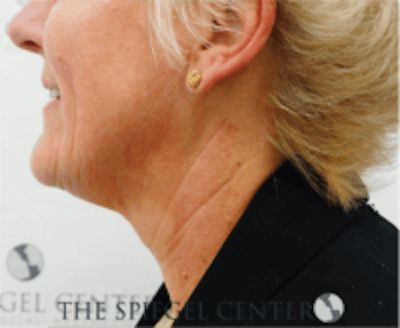 Neck Botox Before & After Gallery - Patient 157140511 - Image 1