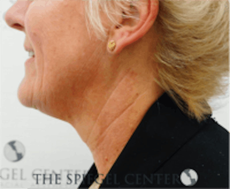 Neck Line Botox Before & After Gallery - Patient 157140511 - Image 1