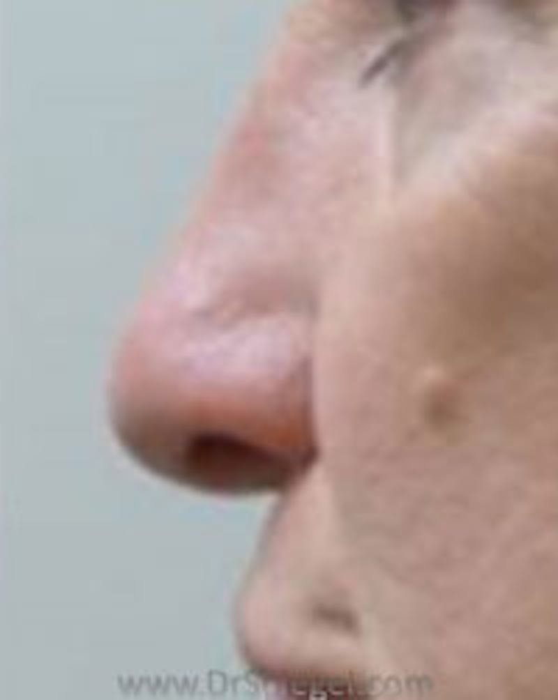 Rhinoplasty Before & After Gallery - Patient 157140512 - Image 2