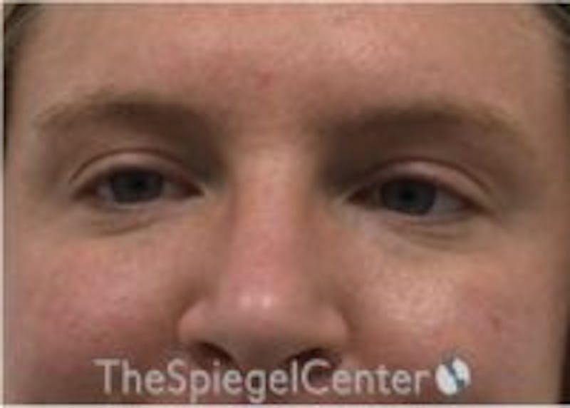 Tear Trough / Under Eye Fillers Before & After Gallery - Patient 157140517 - Image 1