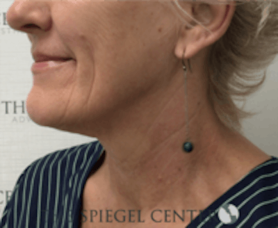 Neck Botox Before & After Gallery - Patient 157140511 - Image 2