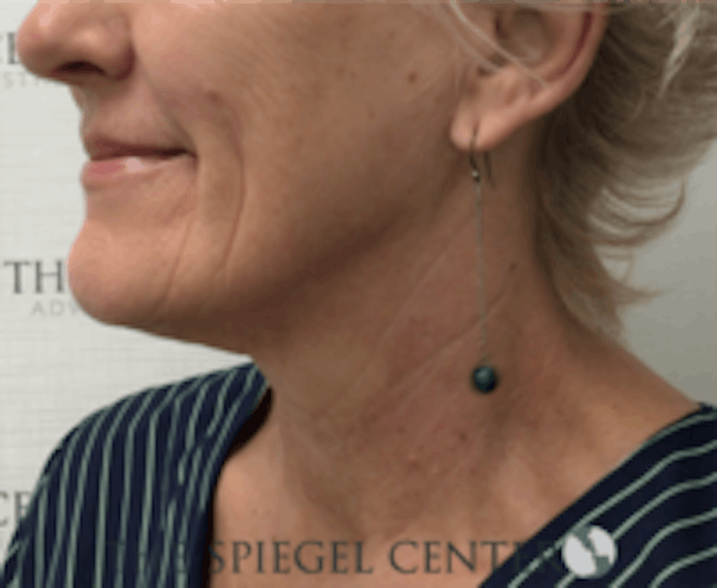 Neck Line Botox Before & After Gallery - Patient 157140511 - Image 2