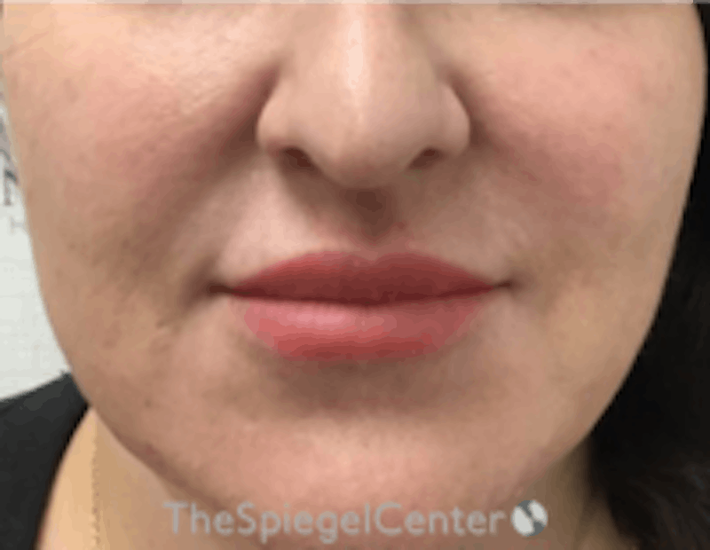 Nasolabial Fold Filler Before & After Gallery - Patient 157140522 - Image 1