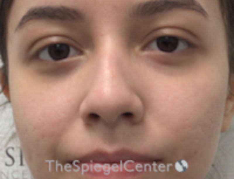 Non-Surgical Rhinoplasty / Nose Filler Before & After Gallery - Patient 157140520 - Image 1