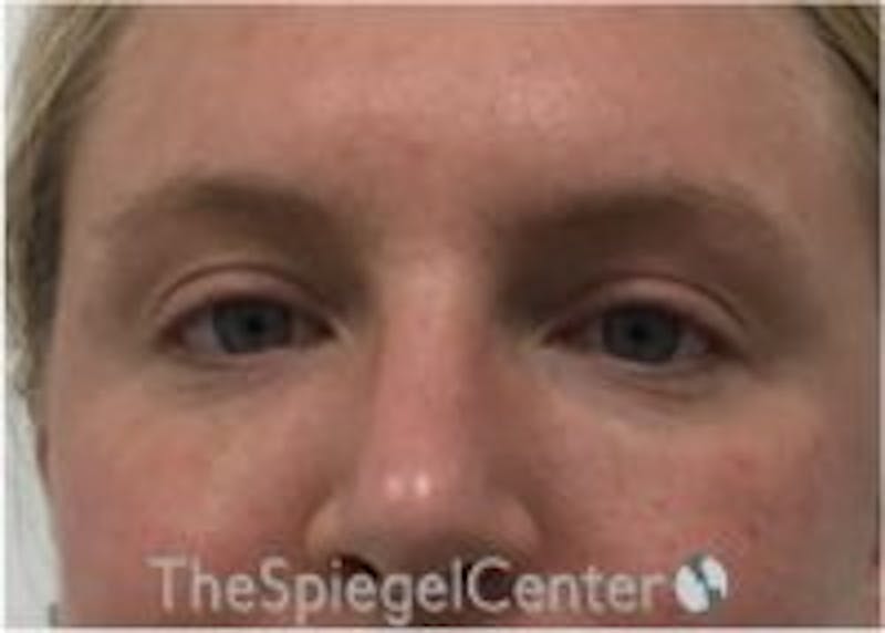 Tear Trough / Under Eye Fillers Before & After Gallery - Patient 157140517 - Image 2