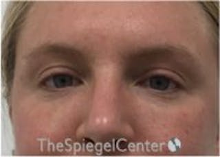 Tear Trough / Under Eye Fillers Before & After Gallery - Patient 157140517 - Image 2