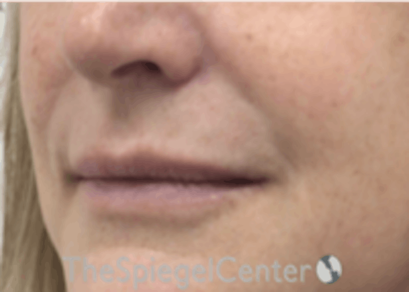 Lip Filler Before & After Gallery - Patient 157140516 - Image 5