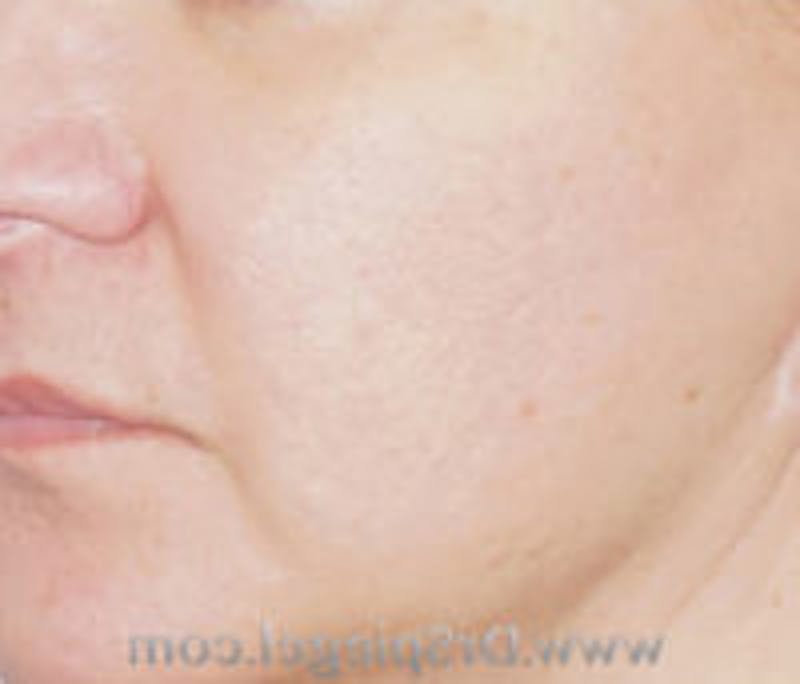 Microneedling Before & After Gallery - Patient 157140513 - Image 2