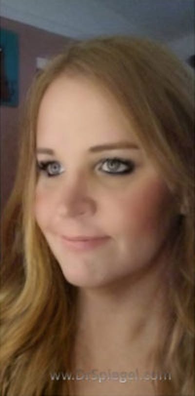 FFS Before & After Gallery - Patient 157140515 - Image 4