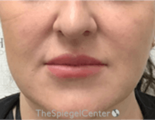 Nasolabial Fold Filler Before & After Gallery - Patient 157140522 - Image 2