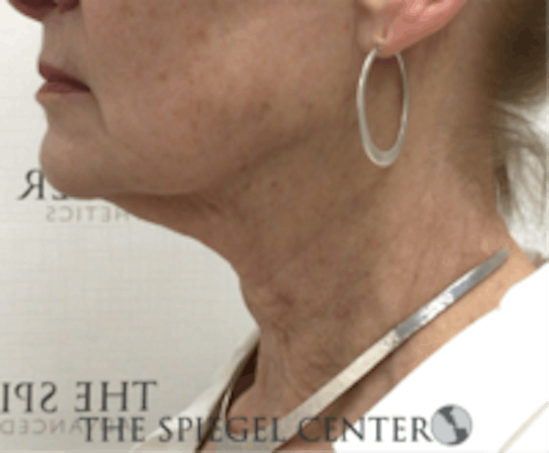 Neck Botox Before & After Gallery - Patient 157140519 - Image 1
