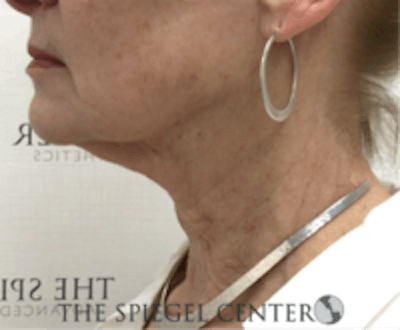 Neck Botox Before & After Gallery - Patient 157140519 - Image 1