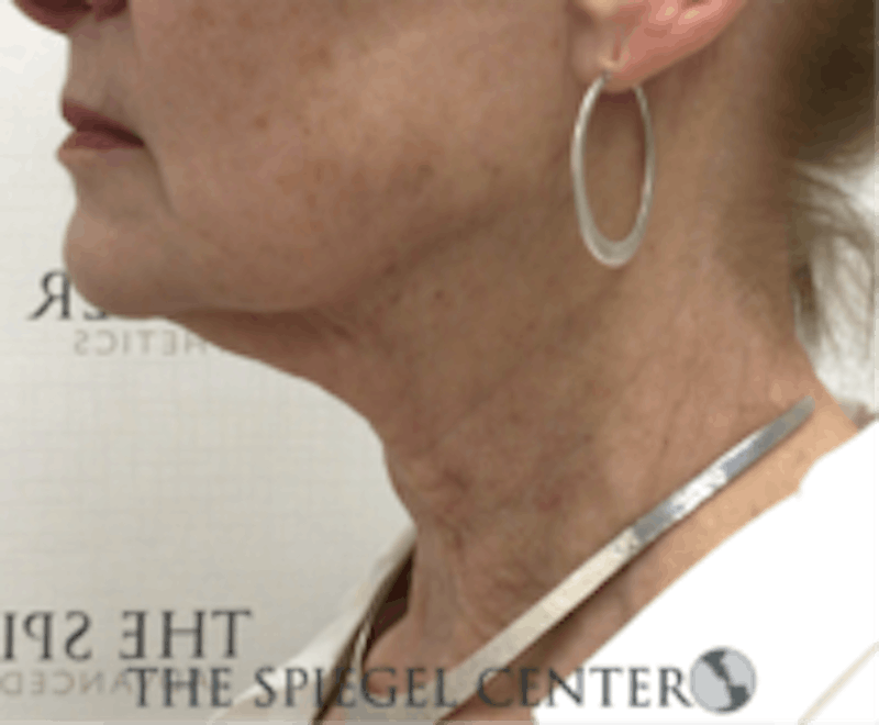 Neck Line Botox Before & After Gallery - Patient 157140519 - Image 1