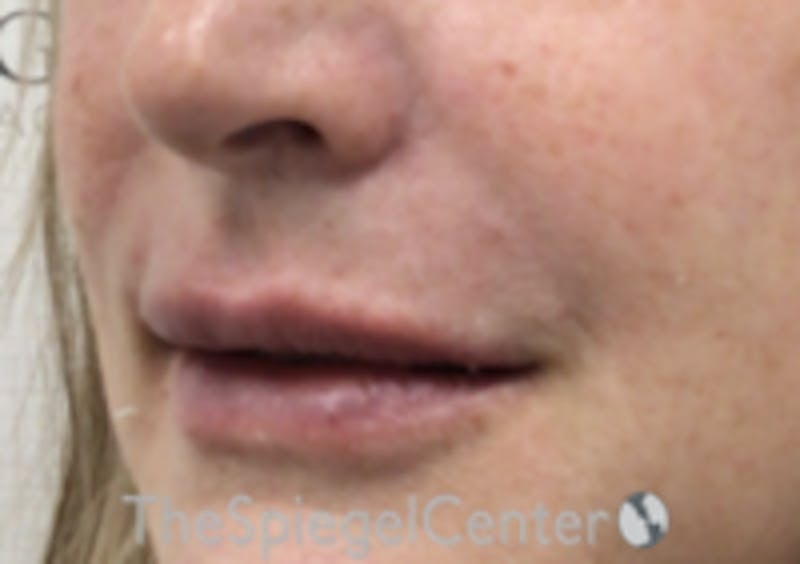 Lip Filler Before & After Gallery - Patient 157140516 - Image 6