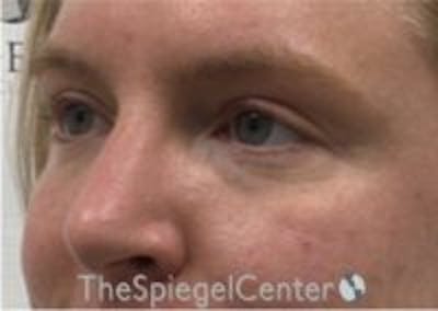 Tear Trough / Under Eye Fillers Before & After Gallery - Patient 157140517 - Image 3