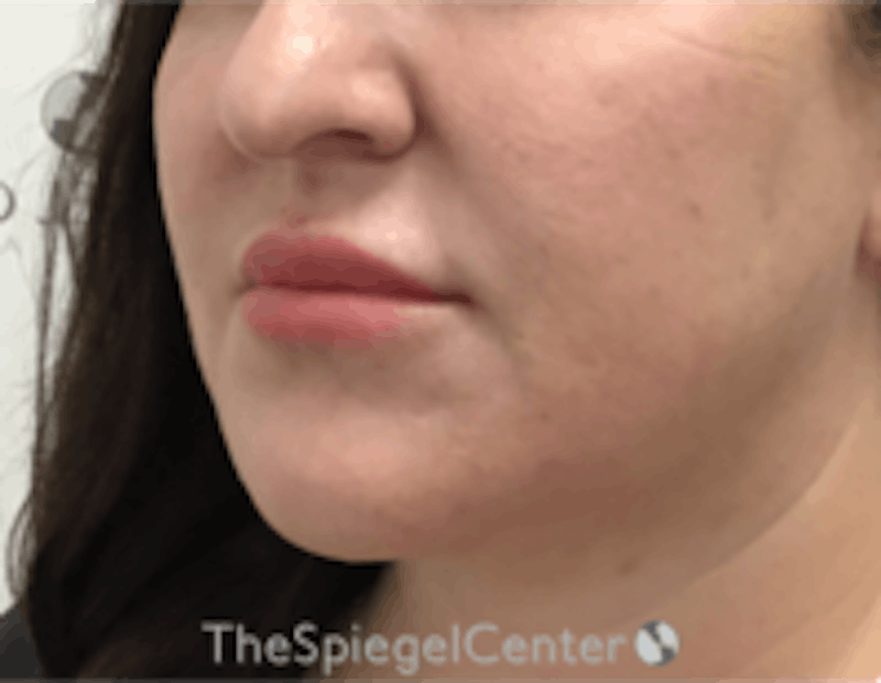 Nasolabial Fold Filler Before & After Gallery - Patient 157140522 - Image 3