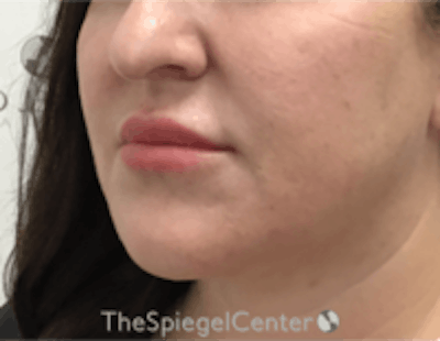 Nasolabial Fold Filler Before & After Gallery - Patient 157140522 - Image 3