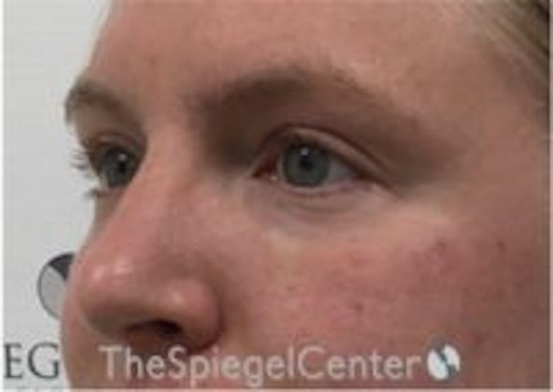 Tear Trough / Under Eye Fillers Before & After Gallery - Patient 157140517 - Image 4