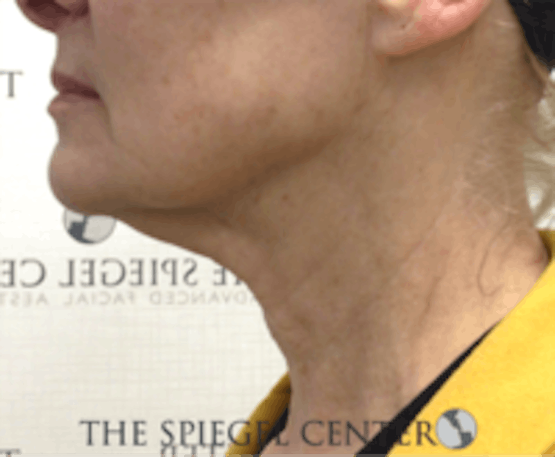 Neck Line Botox Before & After Gallery - Patient 157140519 - Image 2