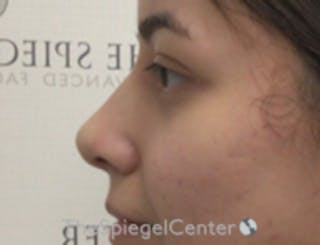 Non-Surgical Rhinoplasty / Nose Filler Before & After Gallery - Patient 157140520 - Image 4