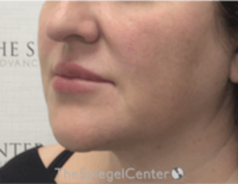 Nasolabial Fold Filler Before & After Gallery - Patient 157140522 - Image 4