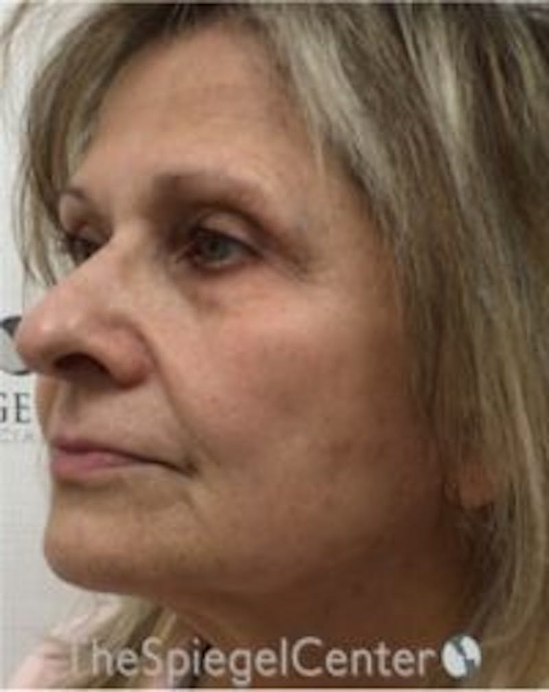 Morpheus8 Before & After Gallery - Patient 157140521 - Image 4