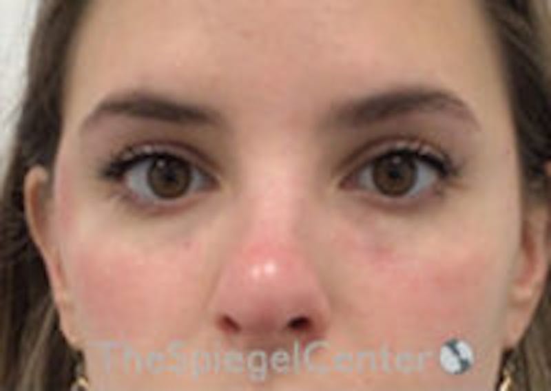 Temple Filler Before & After Gallery - Patient 157140524 - Image 2