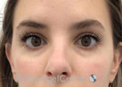 Tear Trough / Under Eye Fillers Before & After Gallery - Patient 157140531 - Image 1