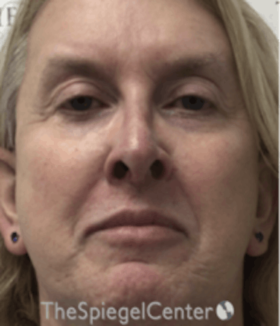 Morpheus8 Before & After Gallery - Patient 157140536 - Image 1
