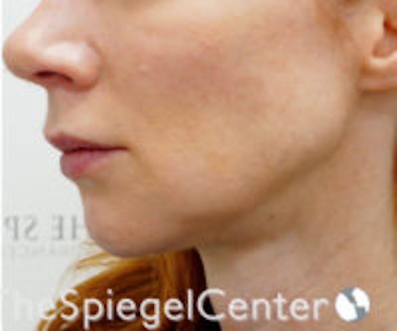 Neck Botox Before & After Gallery - Patient 157140525 - Image 1