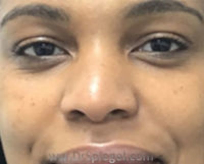 Non-Surgical Rhinoplasty / Nose Filler Before & After Gallery - Patient 157140532 - Image 1