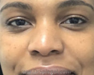 Non-Surgical Rhinoplasty / Nose Filler Before & After Gallery - Patient 157140532 - Image 1