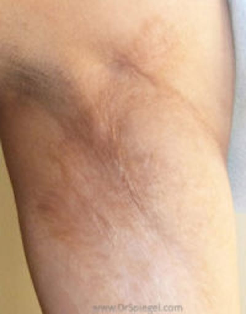 Microneedling Before & After Gallery - Patient 157140527 - Image 1