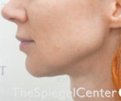Neck Botox Before & After Gallery - Patient 157140525 - Image 2