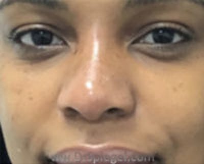 Non-Surgical Rhinoplasty / Nose Filler Before & After Gallery - Patient 157140532 - Image 2