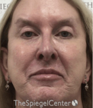 Morpheus8 Before & After Gallery - Patient 157140536 - Image 2