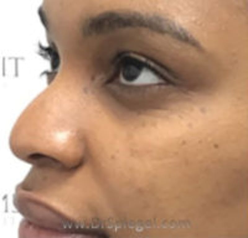 Non-Surgical Rhinoplasty / Nose Filler Before & After Gallery - Patient 157140532 - Image 3
