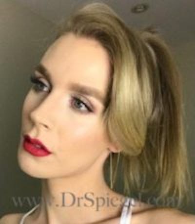 FFS Before & After Gallery - Patient 157140529 - Image 4