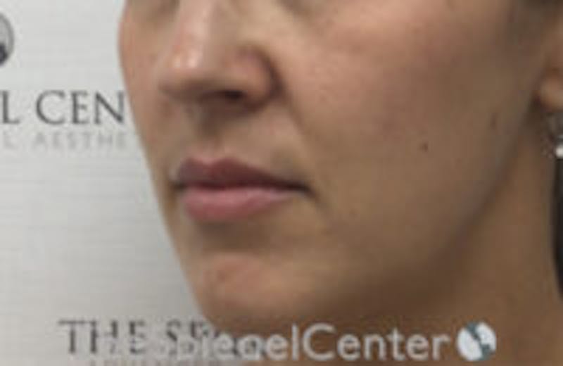 Nasolabial Fold Filler Before & After Gallery - Patient 157140534 - Image 3