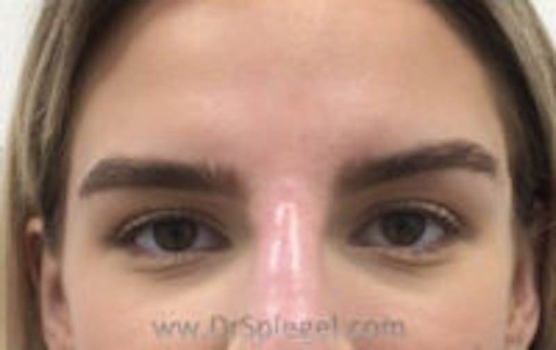 Temple Filler Before & After Gallery - Patient 157140530 - Image 2