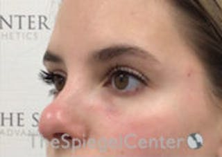 Tear Trough / Under Eye Fillers Before & After Gallery - Patient 157140531 - Image 4