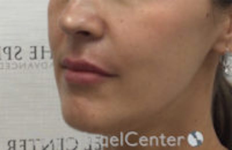 Nasolabial Fold Filler Before & After Gallery - Patient 157140534 - Image 4