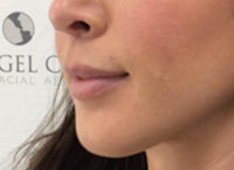 Lip Filler Before & After Gallery - Patient 157140533 - Image 6
