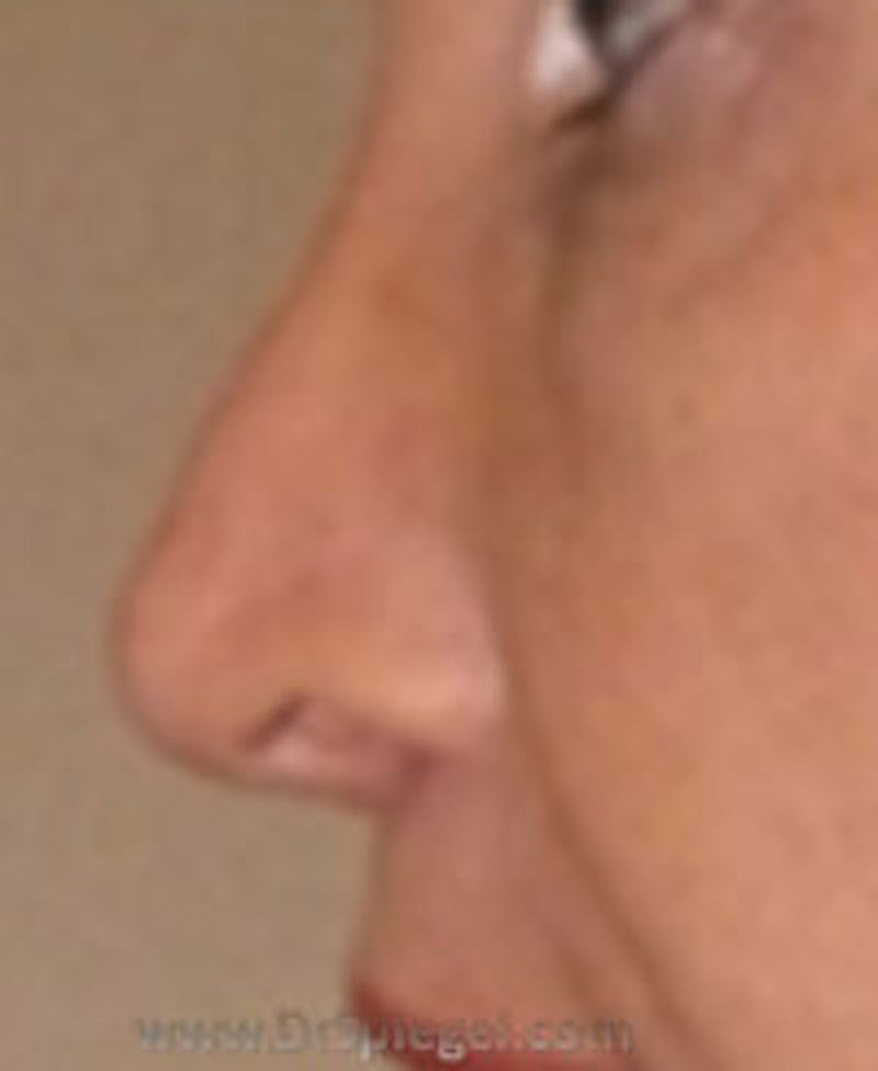 Rhinoplasty Before & After Gallery - Patient 157140535 - Image 2