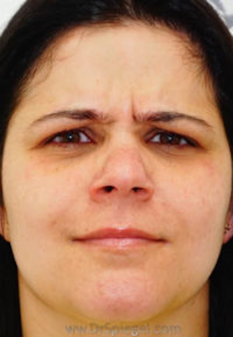 Botox / Dysport / Jeuveau / Xeomin Before & After Gallery - Patient 157140540 - Image 1