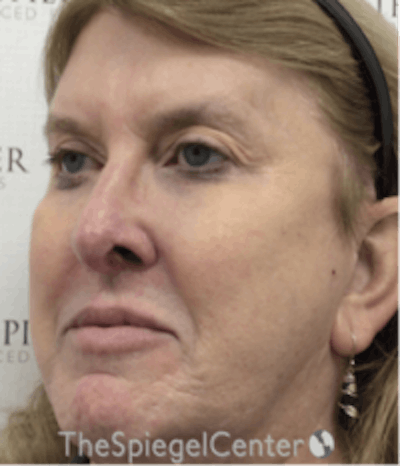 Morpheus8 Before & After Gallery - Patient 157140536 - Image 4