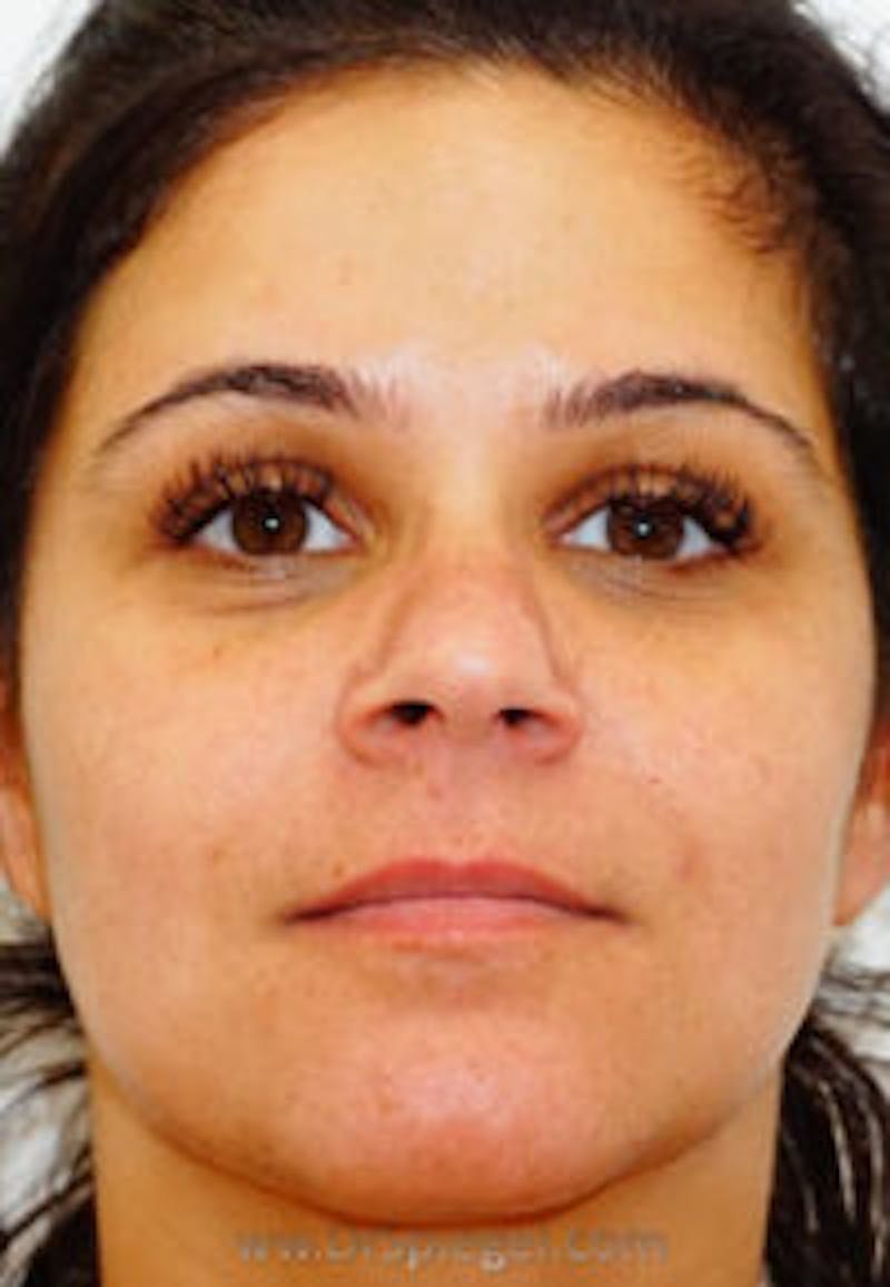 Botox / Dysport / Jeuveau / Xeomin Before & After Gallery - Patient 157140540 - Image 2