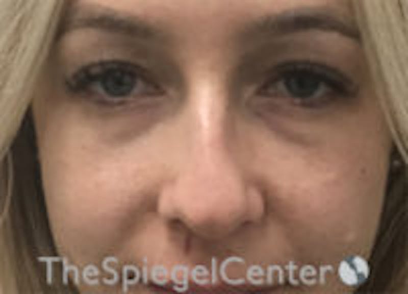 Non-Surgical Rhinoplasty / Nose Filler Before & After Gallery - Patient 157140545 - Image 1