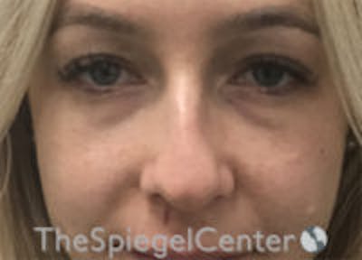 Non-Surgical Rhinoplasty / Nose Filler Before & After Gallery - Patient 157140545 - Image 1